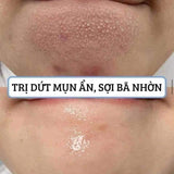 Thanh Lăn Hỗ Trợ Giảm Mụn Đầu Đen So'Natural Red Peel Clear Stick Blackhead & Face Clear Pore Stick