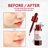 Tinh Chất Tái Tạo, Thay Da Sinh Học So Natural Red Peel Tingle Serum