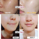 Kem dưỡng giảm thâm Nám Chuyên Biệt Angel's Liquid Tranexamic Mela Zero Cream